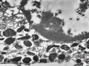 F,21y. | bone marrow - mastocytosis